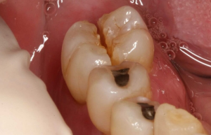 Đau nhức răng hàm trong cùng: Nguyên nhân, triệu chứng và cách chữa trị
