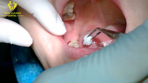 Nhổ răng khôn tại Nha khoa Đồng  được thực hiện một cách tỉ mỉ và an toàn, giúp bạn giảm đau đớn và lo lắng trong quá trình nhổ răng khôn
