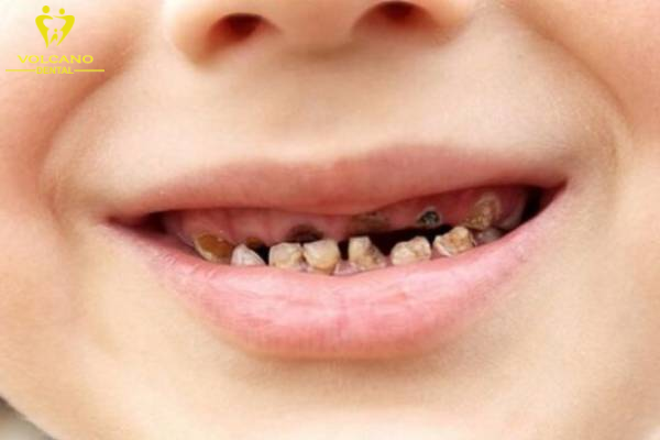 Sâu răng hàm trong giai đoạn 3 (mức độ nặng)
