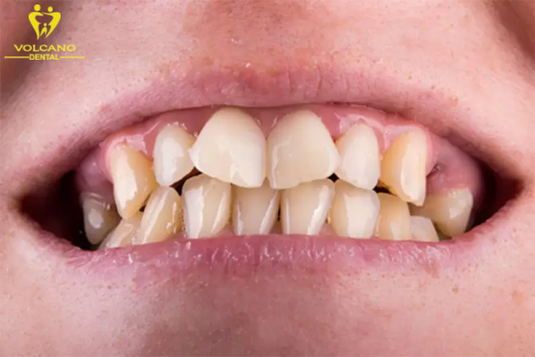 Răng quặp vào trong xảy ra khi các trục răng bị sai lệch vị trí hoặc khi khớp cắn không đúng Răng quặp vào trong xảy ra khi các trục răng bị sai lệch vị trí hoặc khi khớp cắn không đúng