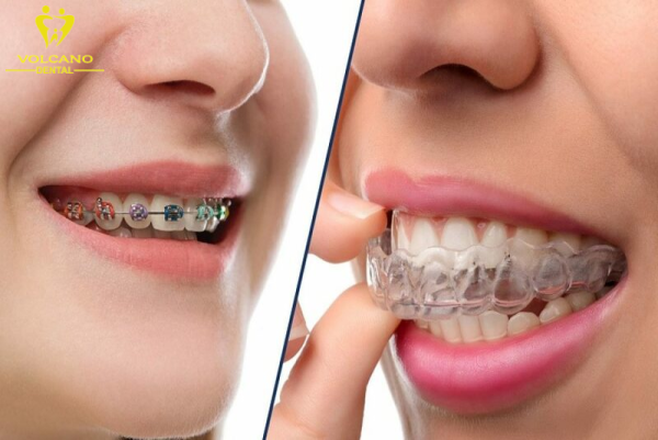 Răng quặp có thể khắc phục bằng cách điều chỉnh răng mắc cài hoặc khay trong suốt Răng quặp có thể khắc phục bằng cách điều chỉnh răng mắc cài hoặc khay trong suốt