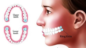 Răng khôn mọc ở đâu? Dấu hiệu và cách nhận biết đơn giản nhất