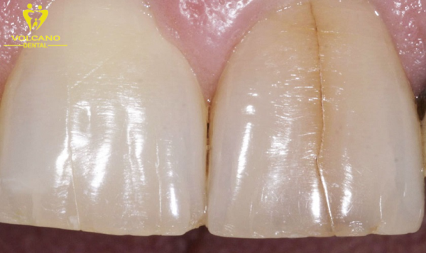 Răng bị nứt có thể gây ra nhiều lo ngại và ảnh hưởng đến chất lượng cuộc sống hàng ngày