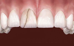 Nguyên nhân khiến răng bị nứt và điều trị khắc phục