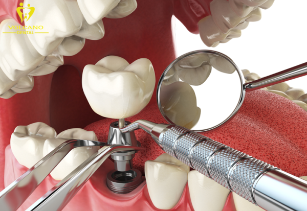 Nhổ răng và trồng răng Implant
