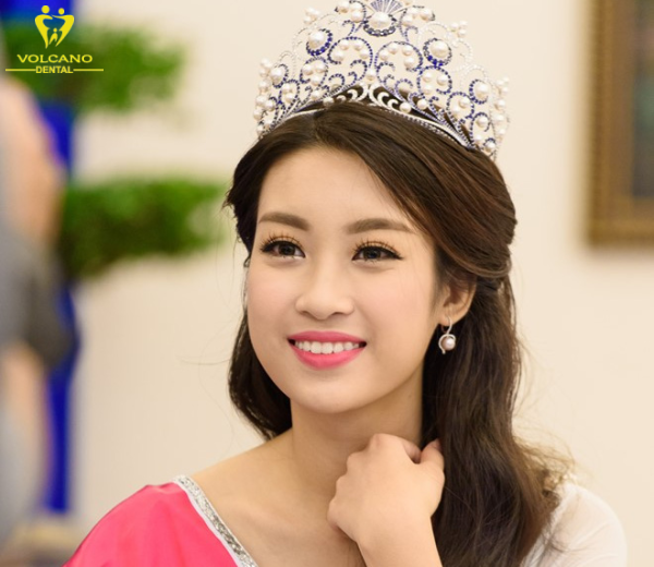 Răng hô duyên Đỗ Mỹ Linh tạo nên nụ cười rạng rỡ, giúp khuôn mặt cô trở nên vô cùng thu hút