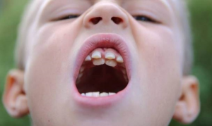 răng mọc ngược