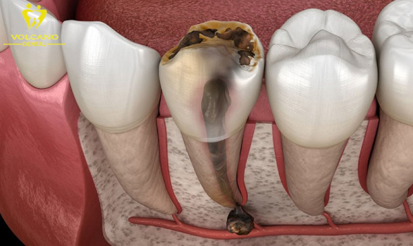 Việc điều trị viêm tủy trước khi bọc sứ là rất quan trọng và không thể bỏ qua Việc điều trị viêm tủy trước khi bọc sứ là rất quan trọng và không thể bỏ qua