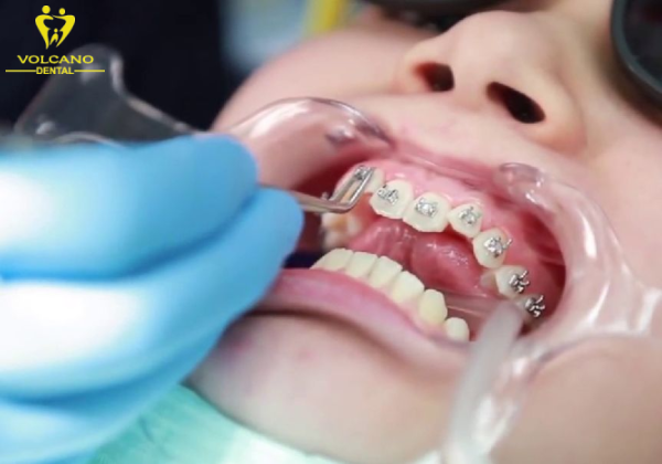Việc chọn nha khoa uy tín có các bác sĩ giàu kinh nghiệm chỉnh nha cho trẻ giúp tiết kiệm chi phí và đạt được kết quả tốt nhất Việc chọn nha khoa uy tín có các bác sĩ giàu kinh nghiệm chỉnh nha cho trẻ giúp tiết kiệm chi phí và đạt được kết quả tốt nhất