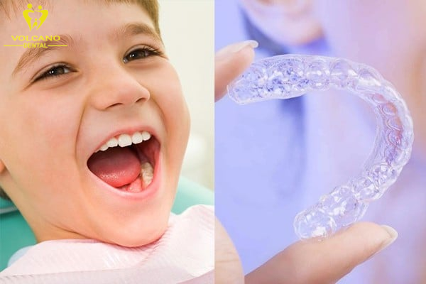Niềng răng trong suốt Invisalign Niềng răng trong suốt Invisalign