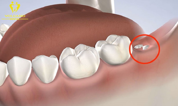 Răng khôn là bốn chiếc răng cuối cùng trong hàng răng sau cùng của hàm răng Răng khôn là bốn chiếc răng cuối cùng trong hàng răng sau cùng của hàm răng