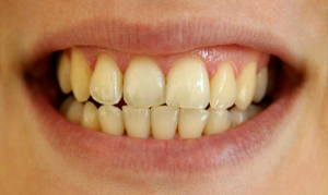 Răng bị ố vàng: Nguyên nhân và cách khắc phục hiệu quả