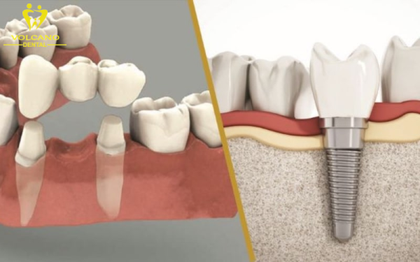 Răng lung lay sau khi nhổ có thể ghép implant để phục hình răng