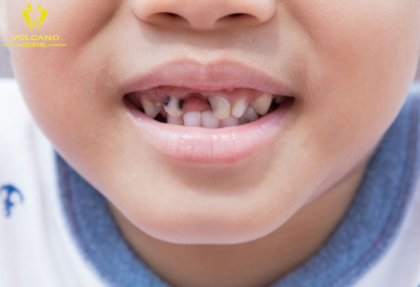 Sâu răng cũng có thể là một nguyên nhân gây ra hiện tượng răng lung lay Sâu răng cũng có thể là một nguyên nhân gây ra hiện tượng răng lung lay