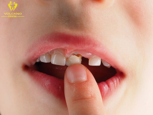 Răng lung lay là tình trạng mà các răng trong hàm không được giữ chặt và vững chắc như bình thường Răng lung lay là tình trạng mà các răng trong hàm không được giữ chặt và vững chắc như bình thường