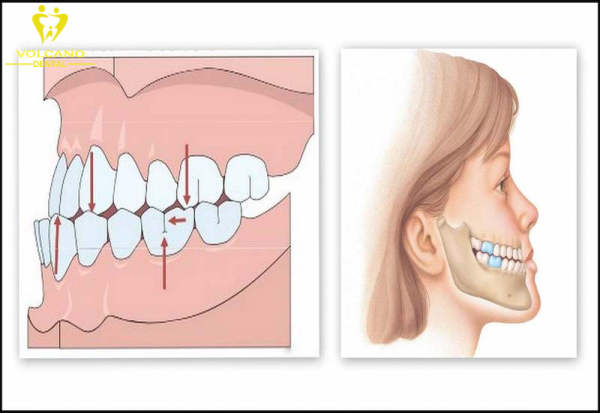 Tình trạng răng móm khiến gương mặt bị lõm và cằm nhô ra, làm cho khuôn mặt mất tính thẩm mỹ Tình trạng răng móm khiến gương mặt bị lõm và cằm nhô ra, làm cho khuôn mặt mất tính thẩm mỹ