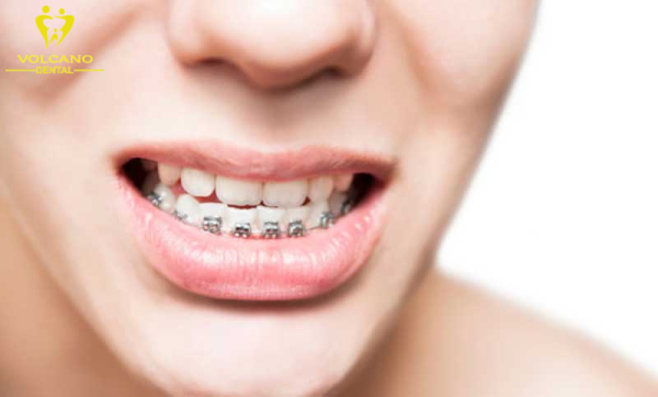 Niềng răng là phương pháp tốt nhất để khắc phục tình trạng răng móm Niềng răng là phương pháp tốt nhất để khắc phục tình trạng răng móm