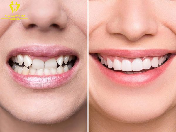 Phương pháp răng sứ là một giải pháp tốt để cải thiện tình trạng răng móm nhẹ Phương pháp răng sứ là một giải pháp tốt để cải thiện tình trạng răng móm nhẹ