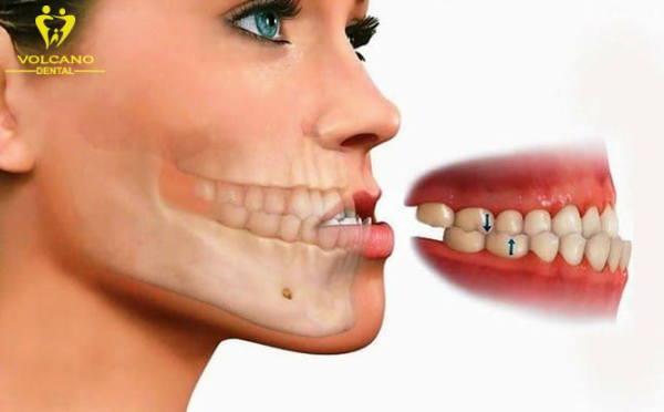 Răng móm ảnh hưởng đến thẩm mỹ và giảm tự tin trong giao tiếp Răng móm ảnh hưởng đến thẩm mỹ và giảm tự tin trong giao tiếp