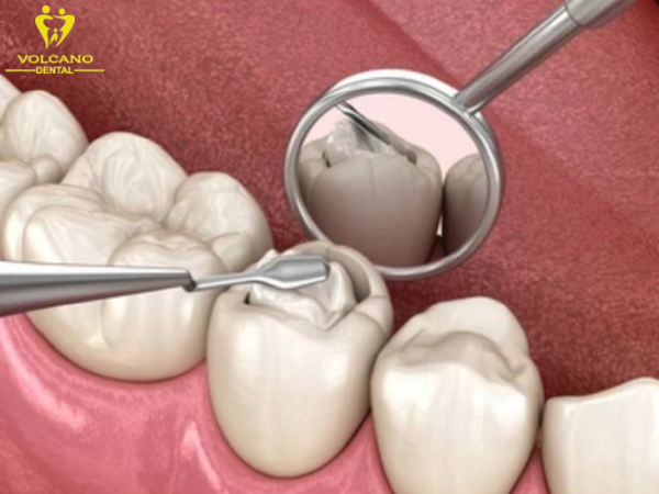 Trám răng là một phương pháp điều trị răng số 7 bị sâu vỡ Trám răng là một phương pháp điều trị răng số 7 bị sâu vỡ