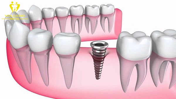 Cấy ghép răng Implant có thể là giải pháp tốt nhất để khôi phục chức năng ăn nhai và cải thiện thẩm mỹ