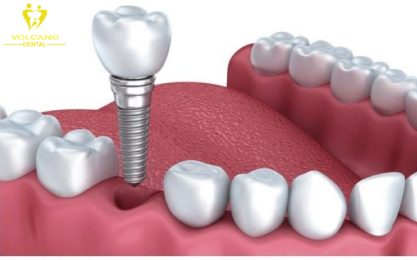 Cấy ghép implant là phương pháp được các chuyên gia khuyến khích phổ biến hiện nay