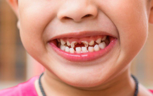 Cách xử lý khi răng sữa của trẻ bị mòn, mẹ cần biết