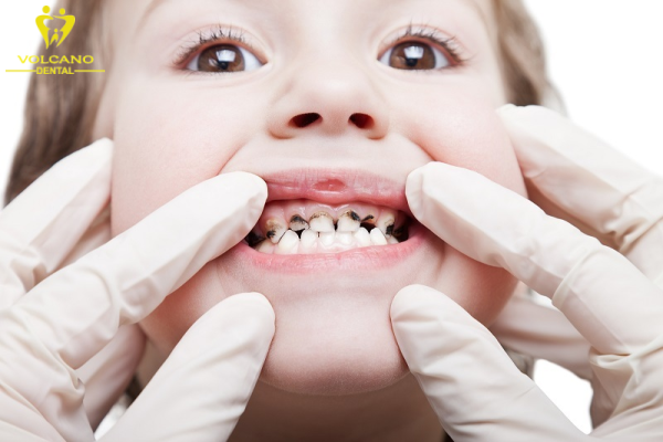 Đa số các bé đều thích ăn đồ ngọt, các loại kẹo, là nguyên nhân dẫn đến sâu răng Đa số các bé đều thích ăn đồ ngọt, các loại kẹo, là nguyên nhân dẫn đến sâu răng