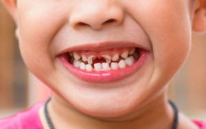 Những cách chữa sâu răng cho trẻ 4 tuổi hiệu quả nhất