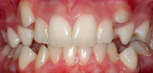 Răng mọc trên lợi: Nguyên nhân và cách khắc phục hiệu quả
