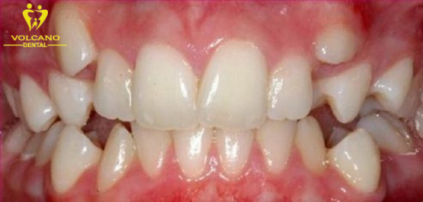 Răng mọc trên lợi là một vấn đề răng miệng phổ biến mà nhiều người gặp phải Răng mọc trên lợi là một vấn đề răng miệng phổ biến mà nhiều người gặp phải