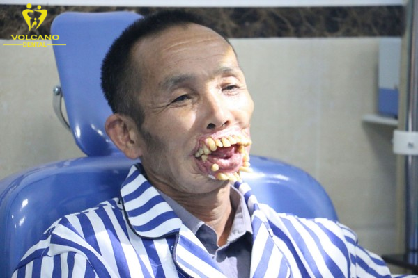 Ông Wu Xiuyou ở Trung Quốc là một trong những người sở hữu hàm răng xấu nhất thế giới