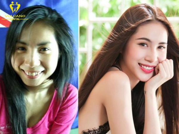 Thủy Tiên đã lựa chọn niềng răng để khắc phục tình trạng mọc khấp khểnh, lệch lạc