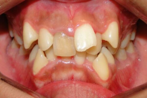 Top 3 hàm răng xấu nhất trên thế giới có thể bạn chưa biết