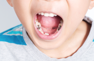 Trẻ 7 tuổi bị sâu răng hàm phải làm sao? Cách điều trị và phòng tránh