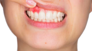 Bị sưng nướu răng trong cùng hàm dưới: Nguyên nhân, cách khắc phục