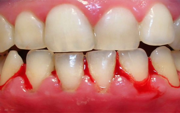 Bị sưng nướu răng trong cùng hàm dưới: Nguyên nhân, cách khắc phục Nướu sưng bị chảy máu khi chải răng là một trong những dấu hiệu sưng nướu răng dưới