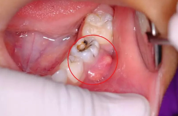 Bị sưng nướu răng trong cùng hàm dưới: Nguyên nhân, cách khắc phục Có nhiều nguy hiểm của sưng nướu răng dưới nếu không được xử lý kịp thời và đúng cách