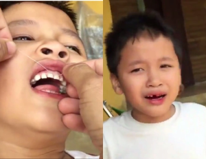 Cách nhổ răng hàm bị sâu tại nhà an toán đúng chuẩn