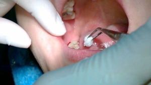 Cách cầm máu khi nhổ răng hiệu quả nhanh chóng tại nhà