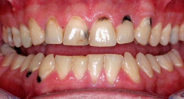 Nhiều nguyên nhân dẫn đến chân răng bị đen Nhiều nguyên nhân dẫn đến chân răng bị đen