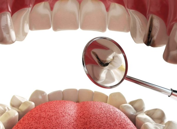Trám răng giúp khắc phục chân răng bị đen do sâu răng Trám răng giúp khắc phục chân răng bị đen do sâu răng