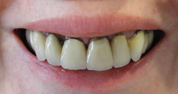 Chân răng bị đen là tình trạng khá phổ biến, ảnh hưởng lớn đến thẩm mỹ Chân răng bị đen là tình trạng khá phổ biến, ảnh hưởng lớn đến thẩm mỹ