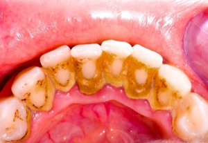Chân răng bị vàng: Nguyên nhân và cách khắc phục hiệu quả