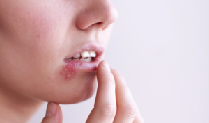 Herpes môi (mụn rộp): Nguyên nhân và cách điều trị hiệu quả
