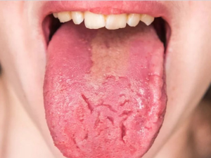 Lưỡi bị nứt: Nguyên nhân, dấu hiệu và cách khắc phục