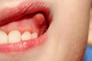 Nổi cục cứng ở lợi: Nguyên nhân và cách điều trị hiệu quả