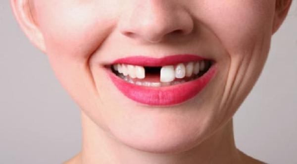 Trồng 2 răng cửa giá bao nhiêu?