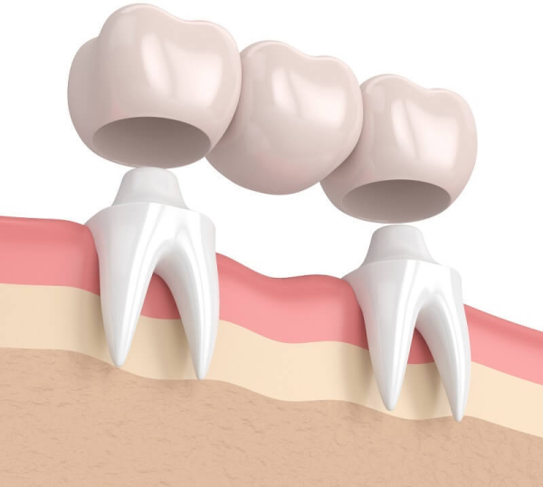 Cầu răng sứ là một trong những phương pháp phổ biến để khắc phục tình trạng mất răng cửa