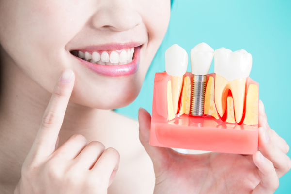 Cấy ghép implant là một phương pháp hiện đại và hiệu quả để khắc phục mất răng cửa